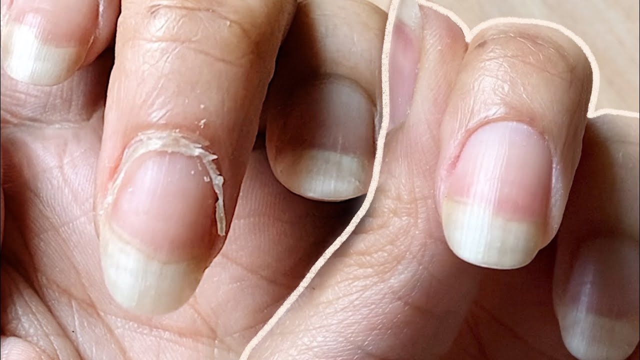 You are currently viewing NAIL TRANSFORMATION