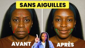 Read more about the article Comment ÉLIMINER les rides du front sans chirurgie