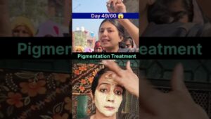 Read more about the article Pigmentation Treatment on Face #pigmentation #pigmentationsolution #skincare#beautytips #shortvideo