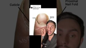 Read more about the article What is your cuticle vs your proximal nail fold |