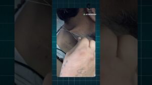 Read more about the article Skin Tags- இனிமேல் பிடுங்காதீர்கள் Dr. Isacc Abbas