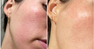 Read more about the article WTF Is Contact Dermatitis? I Asked an Expert For Tips