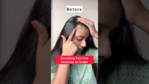 Read more about the article Receding hairline solution at home/hair growth tips/#hairfall #haircare #hair #shorts
