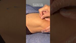 Read more about the article How to #needle the #quads #asmr #massage #youtubeshorts #fitness #health