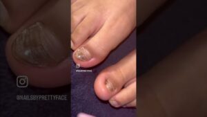 Read more about the article BIG TOE ACRYLIC NAIL! MISSING TOENAIL ACRYLIC