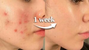 Read more about the article how to HEAL YOUR SKIN BARRIER in 1 week *naturally*