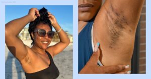 Read more about the article How I Learned to Love My Bumps and Scars From