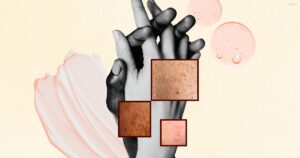 Read more about the article Real Couples Share How Chronic Skin Conditions Impact Their Relationships