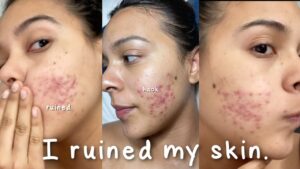 Read more about the article I Ruined My Skin with this Beauty Hack