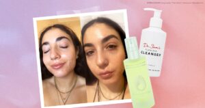 Read more about the article Accutane Made My Skin Dry, but These Products Solved the